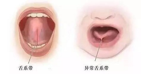 舌系帶過長影響孩子發(fā)音，嚴(yán)重不會說話